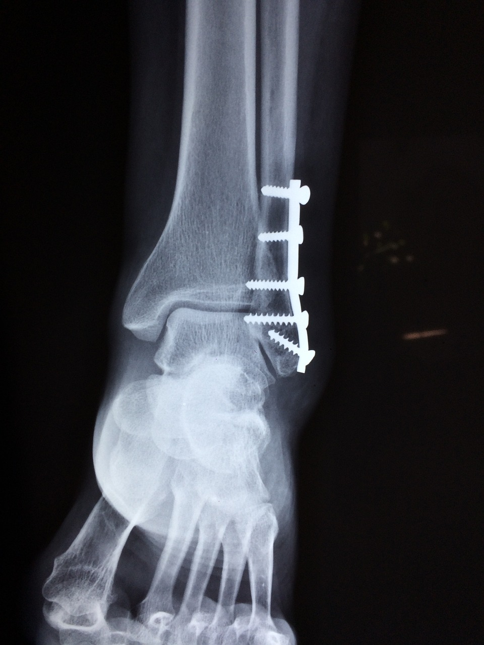 ankle, fracture, foot-2253057.jpg