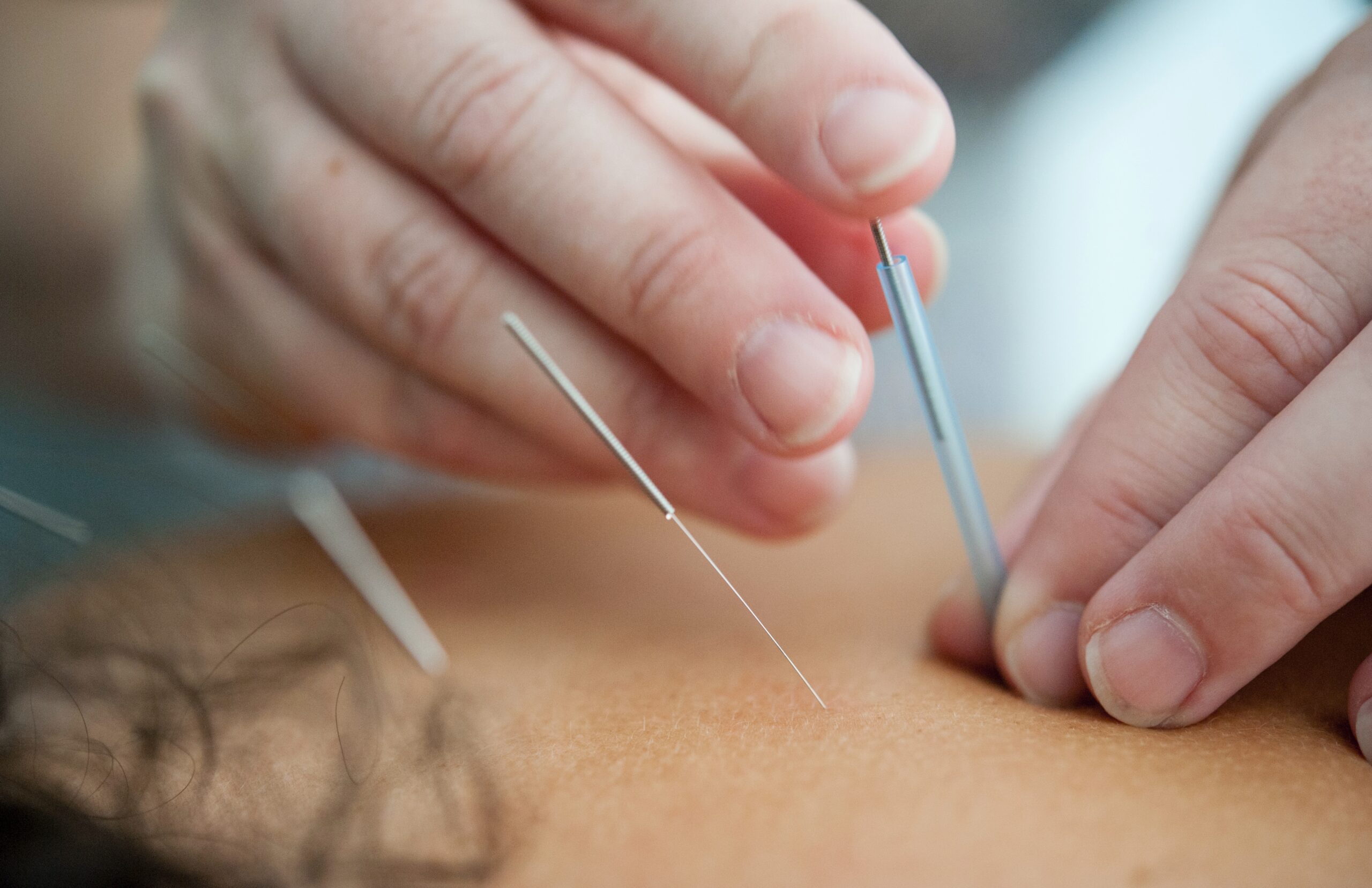 Pain-management-acupuncture