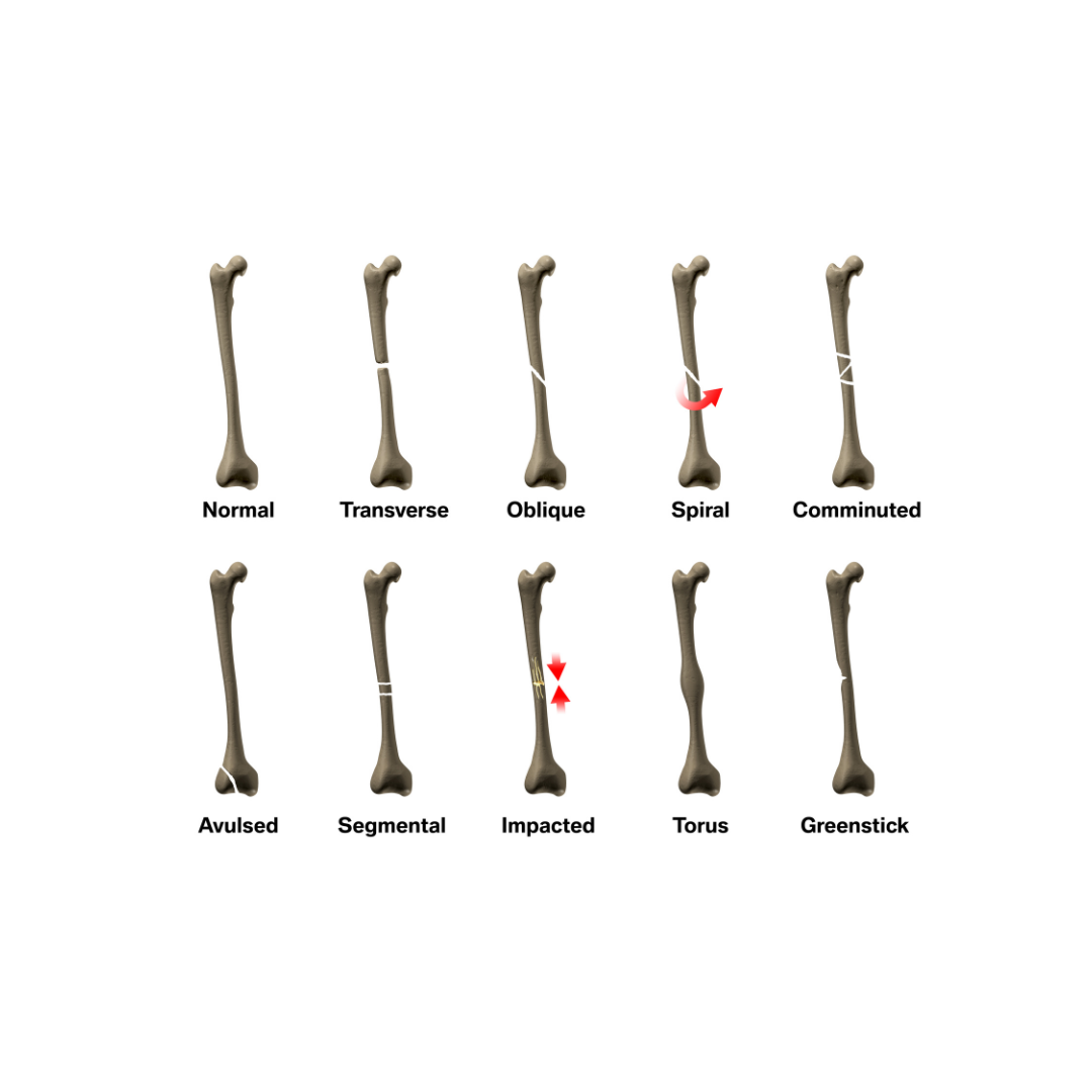 An illustration of various type of bone fractures