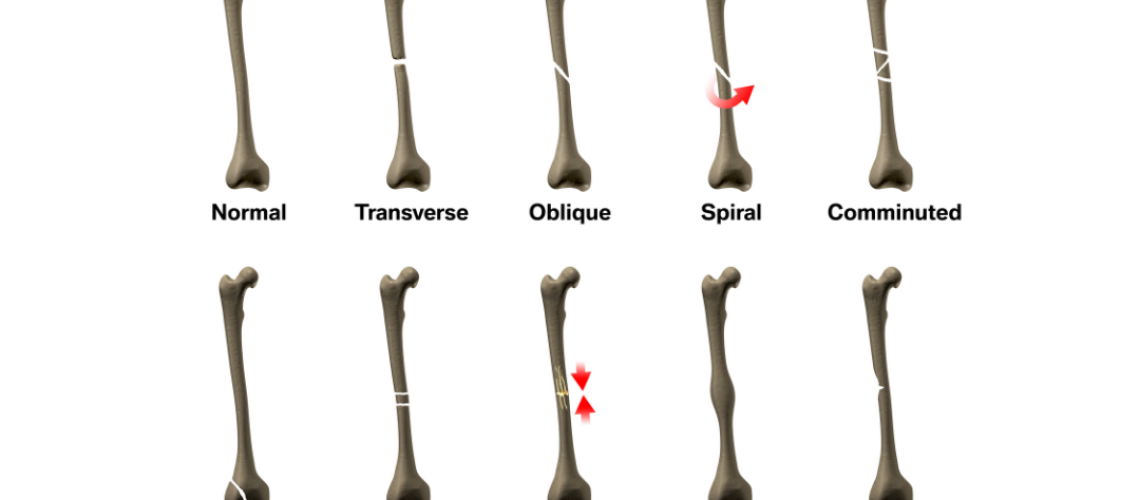 An illustration of various type of bone fractures