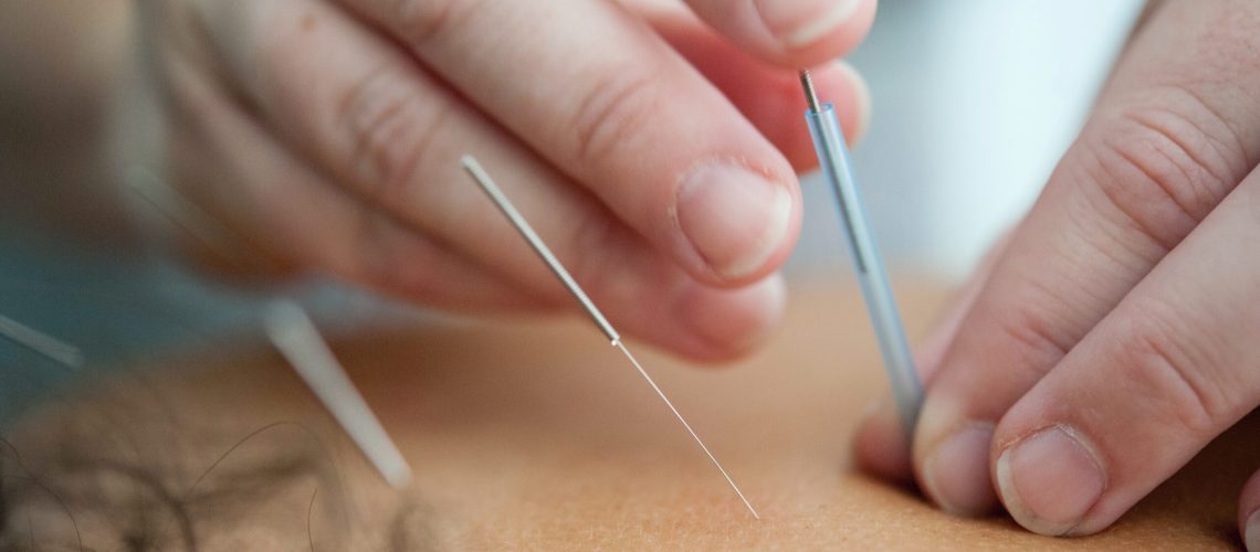 Pain-management-acupuncture