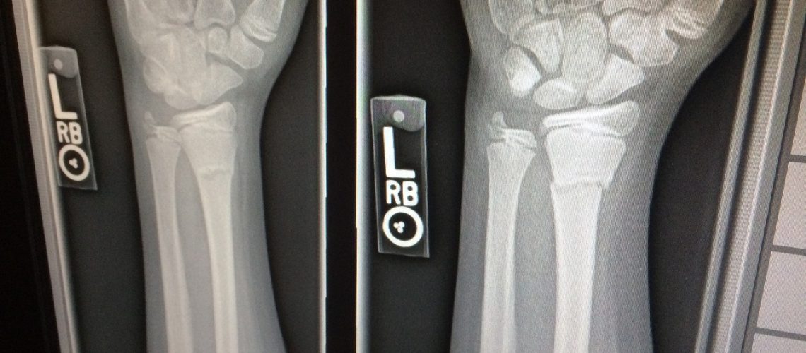 x-ray, medical, broken-1273382.jpg